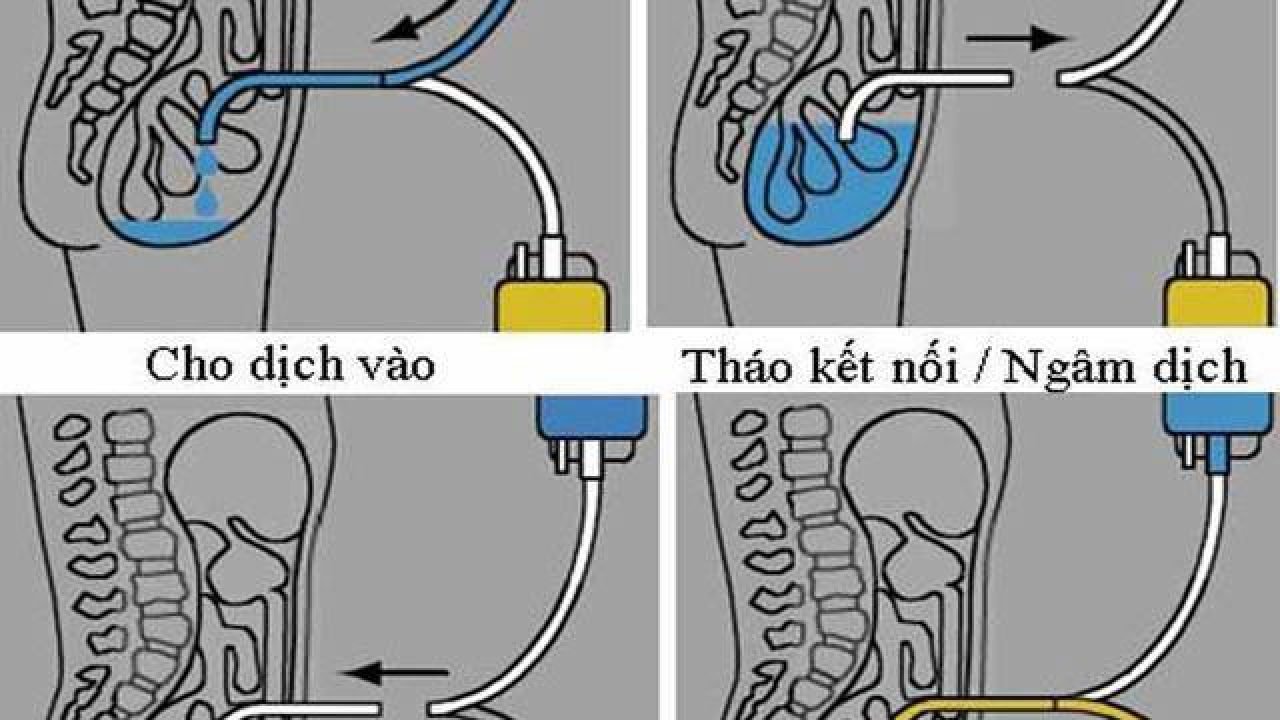 Lọc màng bụng ở người cao tuổi Lọc màng bụng ở người cao tuổi