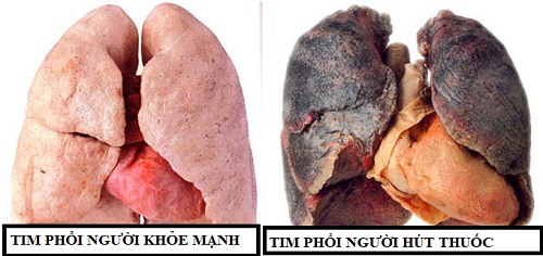 tim phổi người hút thuốc lá